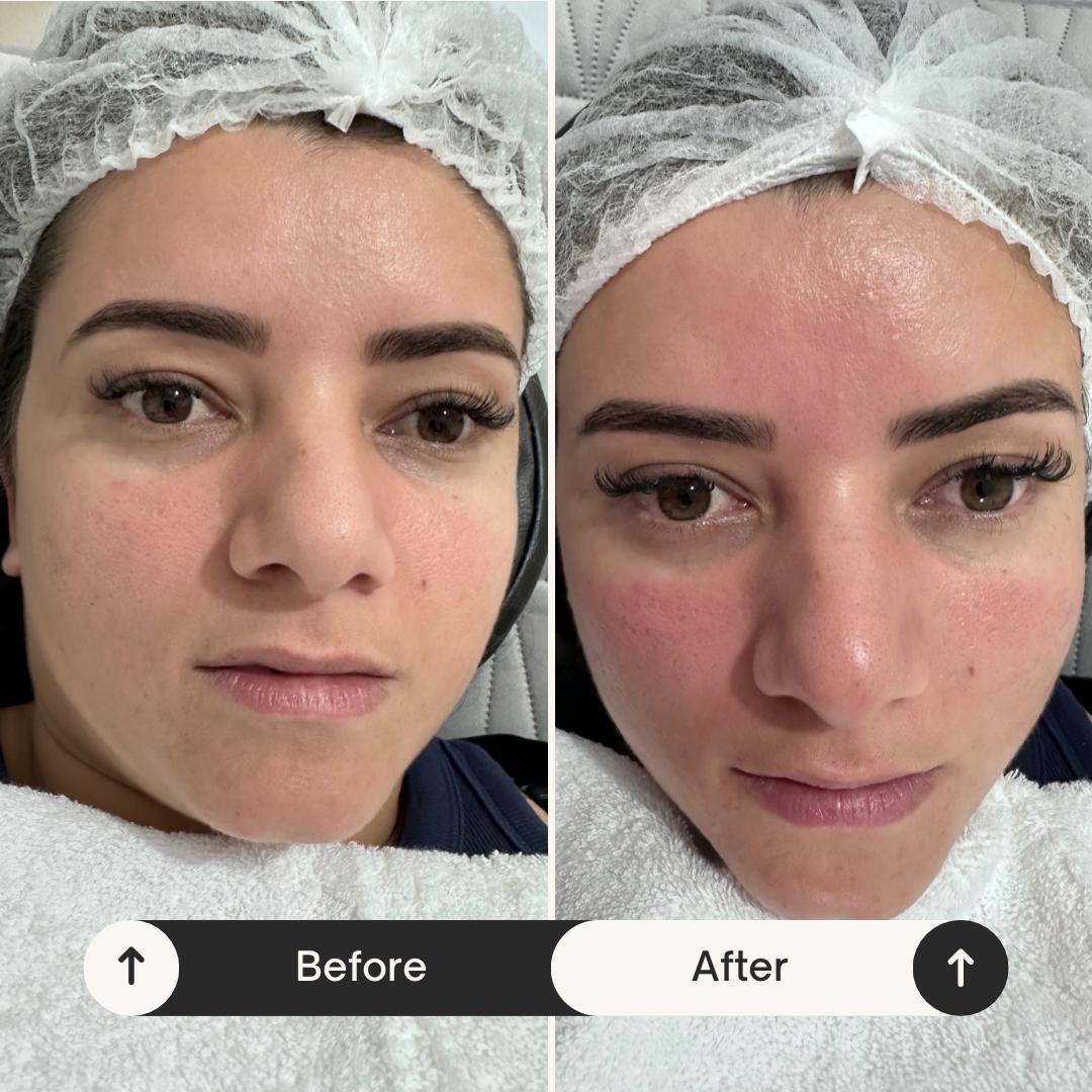 Real client before and after a facial treatment