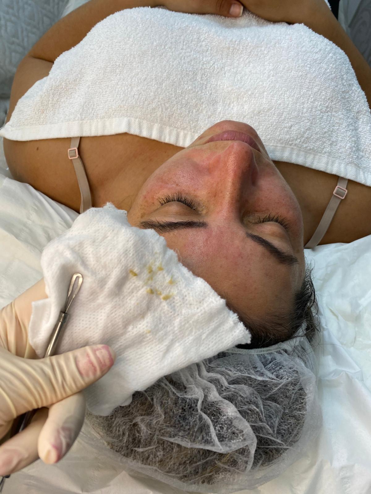 Facial extraction in progress